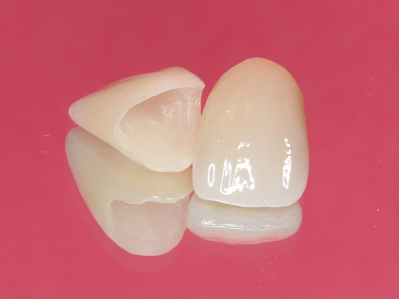 健康保険でできる白いかぶせ物です