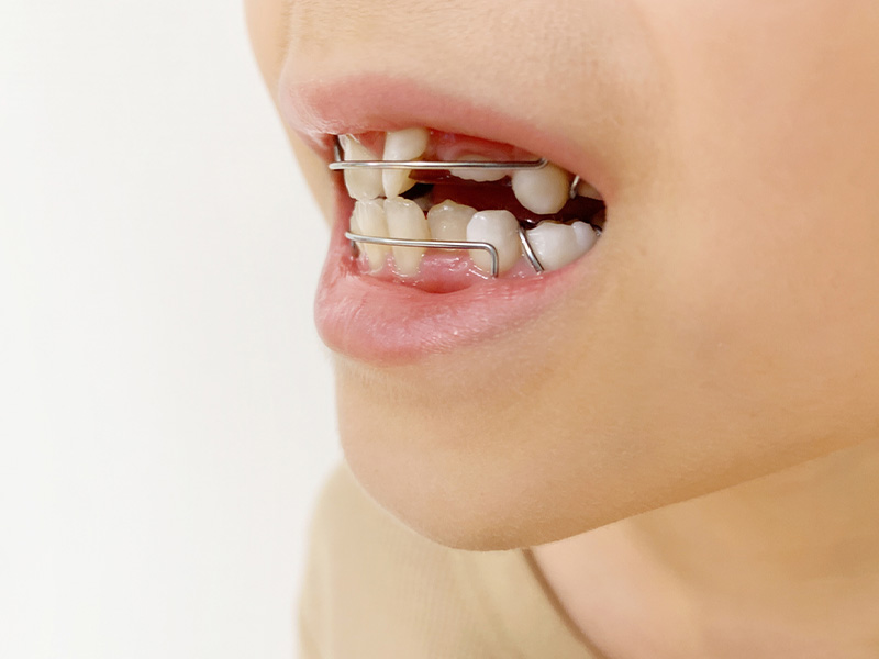 矯正治療の重要性